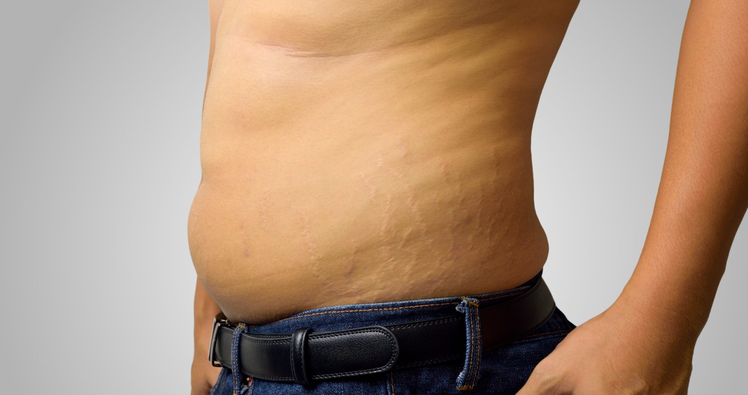 Invisible Armor: Concealing Stretch Marks with Confidence